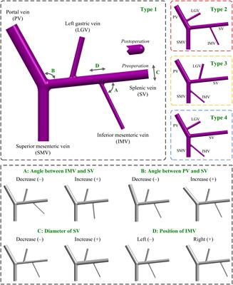 Influences of Anatomorphological Features of the Portal Venous System on Postsplenectomy Hemodynamic Characteristics in Patients With Portal Hypertension: A Computational Model-Based Study